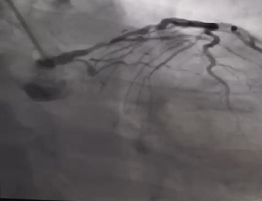 https://bhagwatkarheartcare.com/wp-content/uploads/2021/03/Complex-Double-Vessel-Angioplasty-1.jpeg